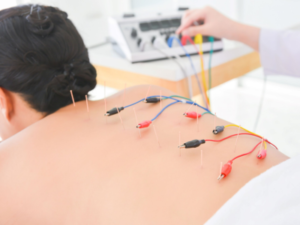 Electro-acupuncture