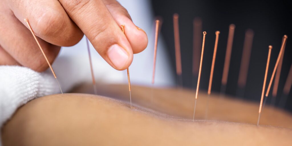 acupuncture