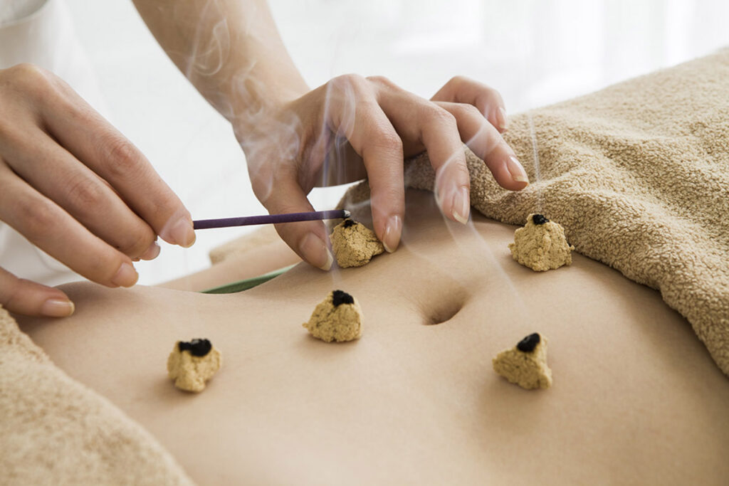 moxibustion