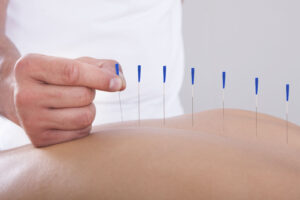 Acupuncture for Fertility