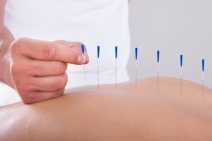  Acupuncture Help with Back Pain