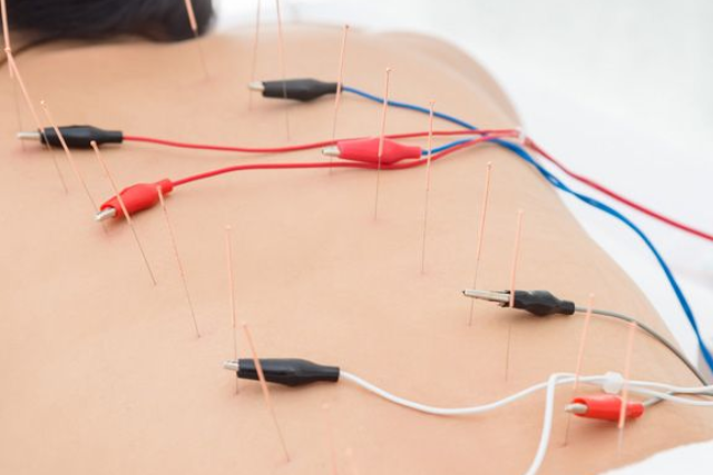 electro acupuncture