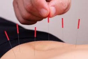 acupuncture for stress management