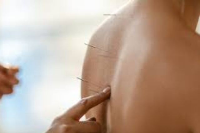 Acupuncture for Sciatica