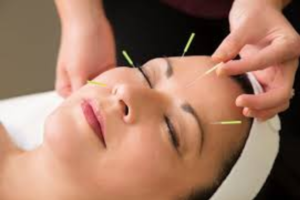 acupuncture for stress management