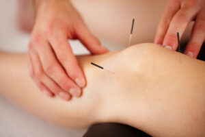  Acupuncture Treat Arthritis Pain