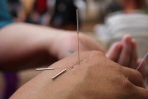 acupuncture for stress management