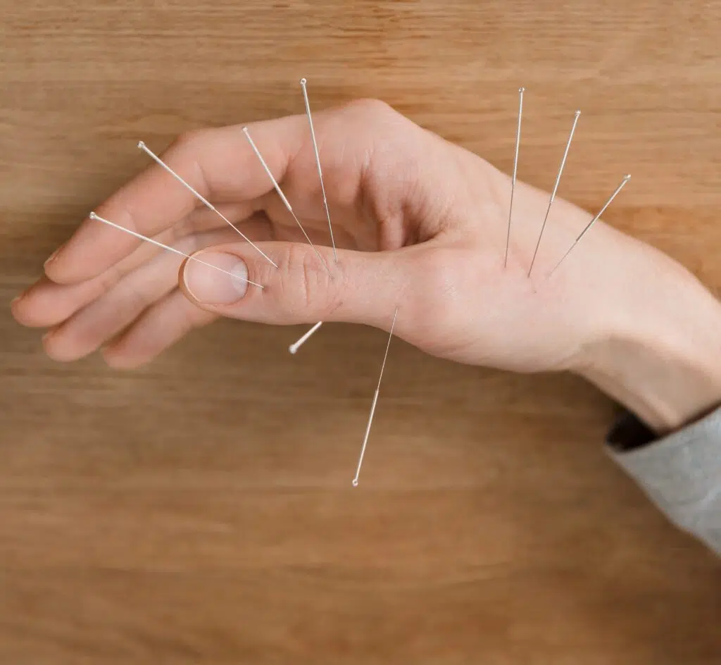 Advanced Acupuncture in Christchurch